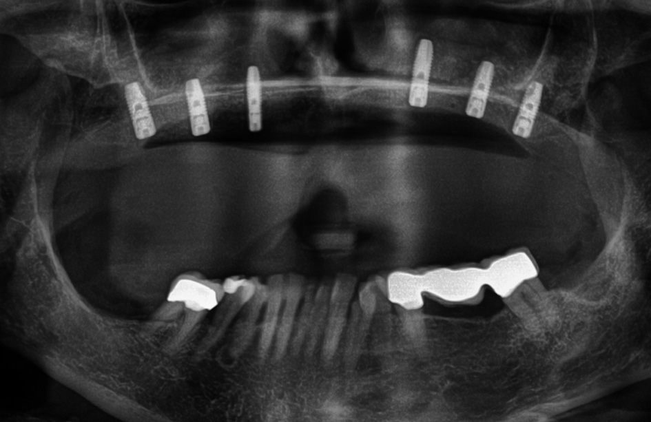 Abb. 18: Das postoperative Röntgenbild zeigt die sechs inserierten Implantate im Oberkiefer.