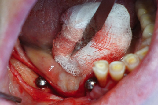 Abb. 28: Offene Implantation nach DVT-Messung und Bestimmung der vertikalen Höhe.