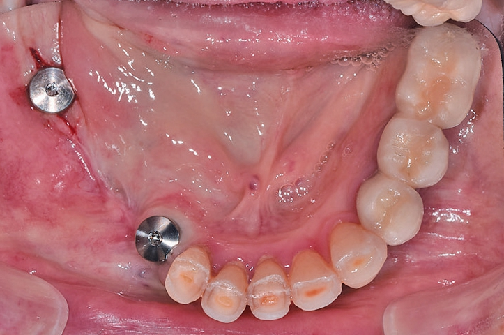 Abb. 30: Implantate in situ. Regio 46: 4 mm, regio 43, 12 mm.