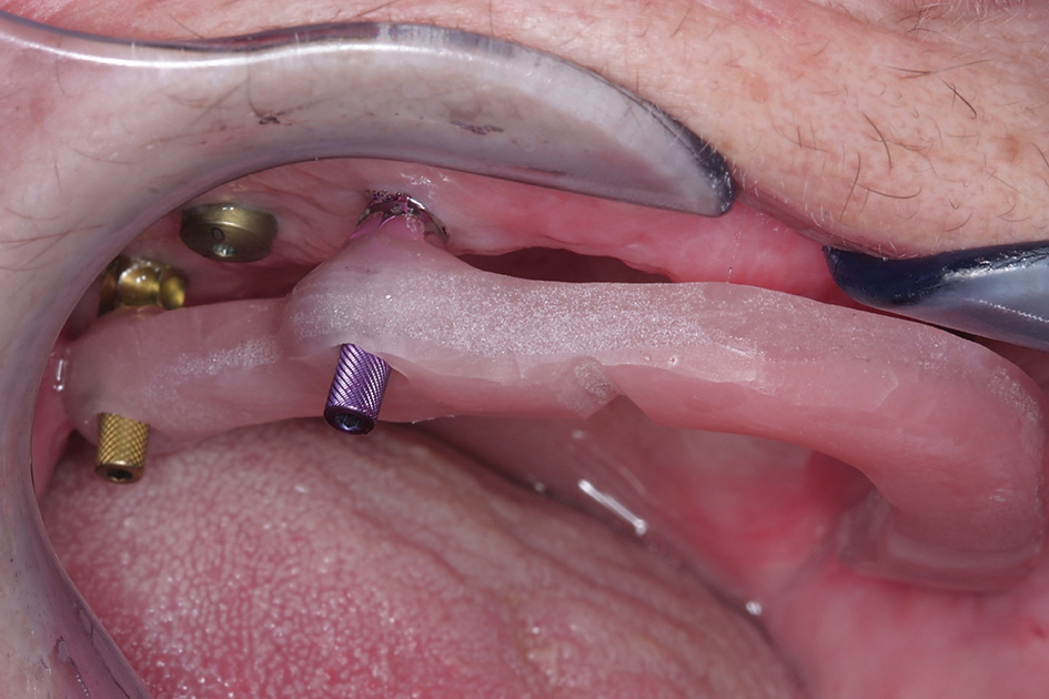 Abb. 24: Durch eine verschraubte Bissnahme erreicht man eine optimale Übertragung der intraoralen Situation auf das Meistermodell und erspart sich damit unnötiges und zeitaufwändiges späteres Einschleifen am Patienten.