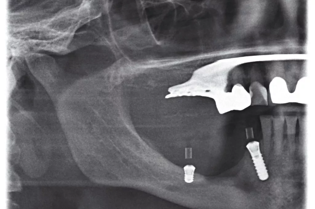 Abb. 31: OPG-Kontrolle post Implantation.
