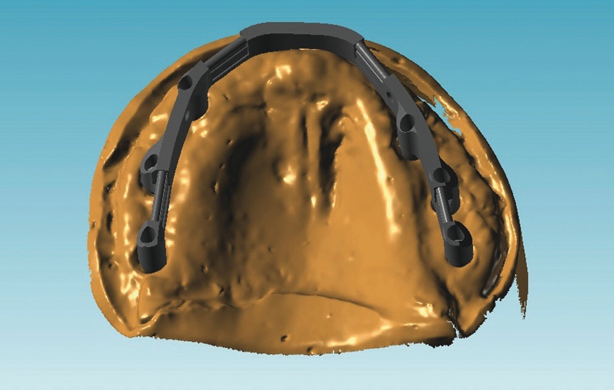 Abb. 25: Digitale Planung der Stegkonstruktion (ISUS/Atlantis Dentsply Sirona).