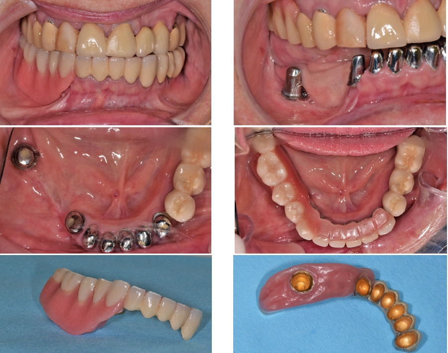 Abb. 32 bis 37: Definitiver Zahnersatz, teleskopierend abnehmbar (3 Monate post Implantation).