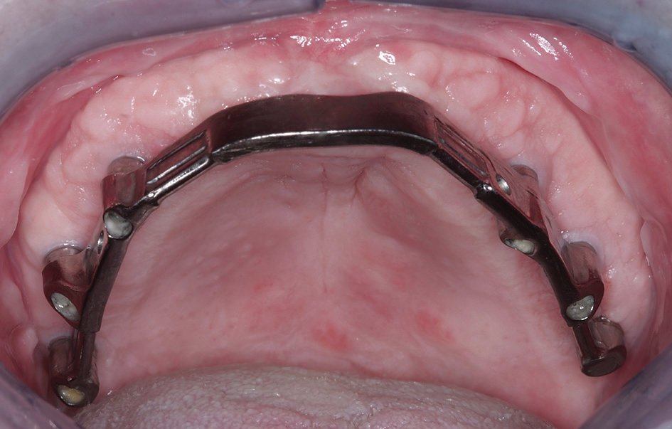 Abb. 26: Der intraoral eingegliederte CAD/CAM-Steg und die periimplantär gut verheilte keratinisierte Mukosa-Manschette für langfristig stabile Verhältnisse.