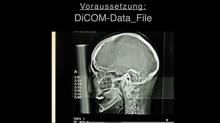 Abb. 2a: Follow-up einer Implantat-Planung: Digitale DVT-Schablone,...