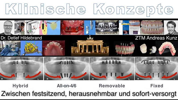 Abb. 3: Klinische Konzepte in der Implantologie im Wettstreit.