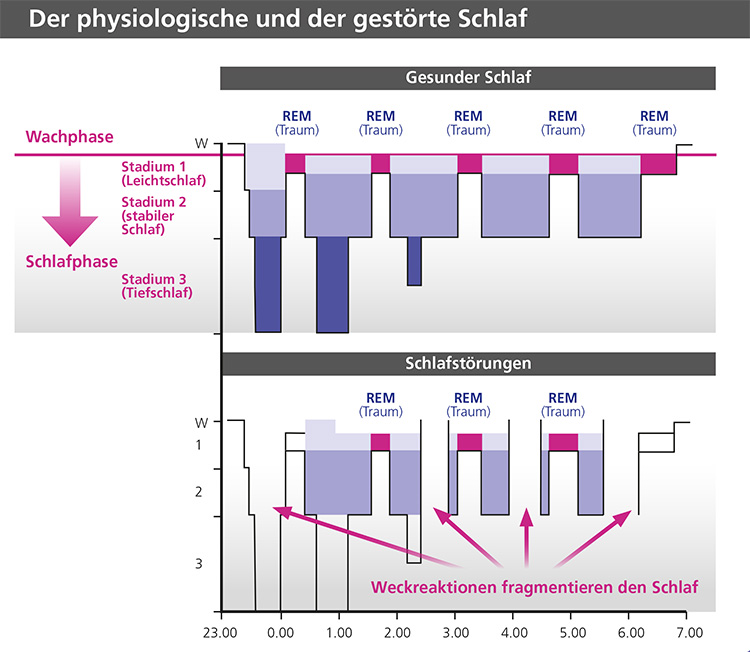 Abb. 1: Gesundes und gestörtes Schlafprofil. Während beim gesunden Schlaf ausreichend Tief- und
REM-Schlafphasen vorkommen, werden diese Anteile bei einer Fragmentierung der Schlafarchitektur durch
Weckreaktionen, z.B. bei einer Schlafapnoe, stark reduziert. Dadurch können sich sowohl körperliche als
auch seelische Beschwerden einstellen, je nach Vulnerabilität der Patienten/-innen.