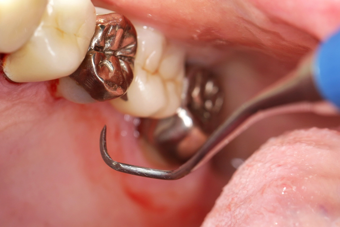Abb.: 1a: Subgingivale Instrumentierung mit Handinstrumenten.