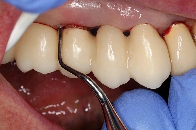 Abb.: 1b: Subgingivale Instrumentierung mit Handinstrumenten.