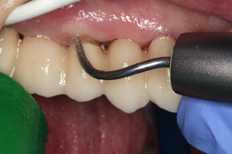 Abb. 2b: Subgingivale Instrumentierung mit maschinellen Instrumenten (hier: Airscaler).