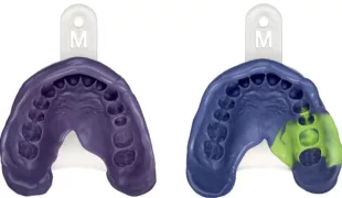 Von Anwendern empfohlen: 3M Impregum Super Quick Polyether Abformmaterial (links: Monophasentechnik mit Medium Body, rechts: Doppelmischtechnik mit Heavy Body und Light Body Material).