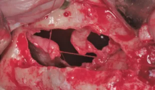 Die Perforation wird mittels 6-0 resorbierbarer Naht verschlossen.