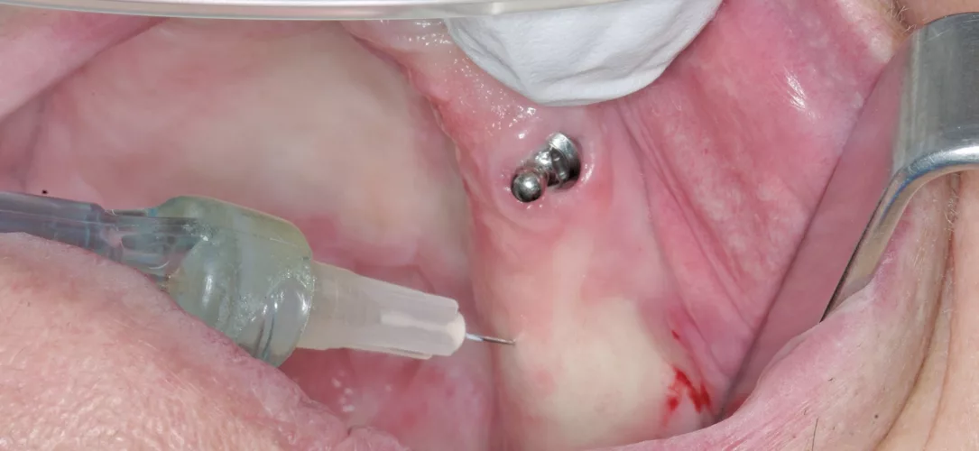 Die Implantation erfolgt unter minimalinvasiver intraligamentärer Anästhesie.