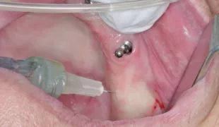 Die Implantation erfolgt unter minimalinvasiver intraligamentärer Anästhesie.