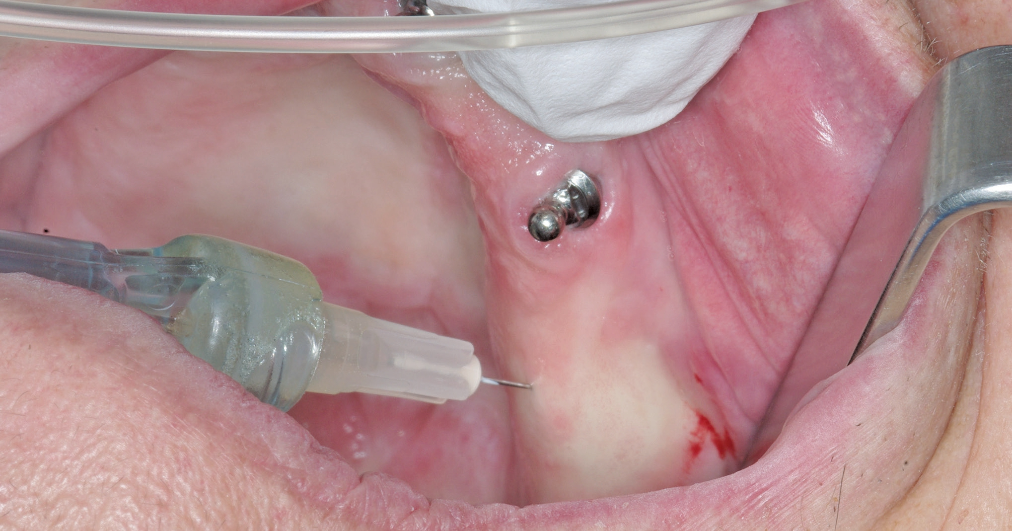 Die Implantation erfolgt unter minimalinvasiver intraligamentärer Anästhesie.