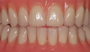 Kontrolle der Exzentrik bei Protrusion.