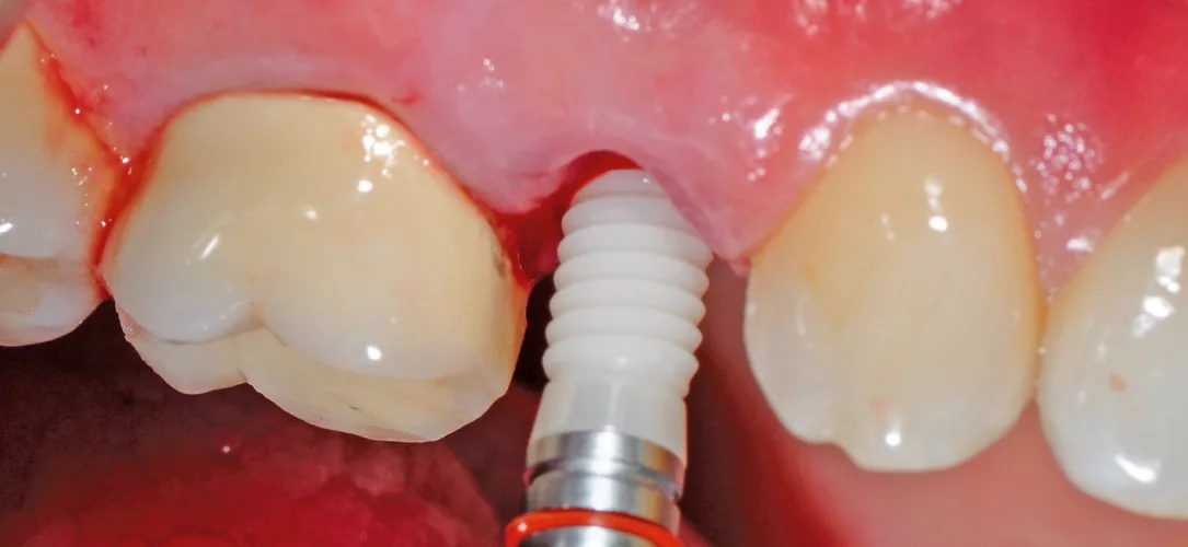 Langsam wurde das yttriumstabilisierte Implantat in das Knochenbett inseriert.