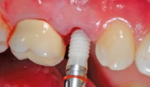 Langsam wurde das yttriumstabilisierte Implantat in das Knochenbett inseriert.