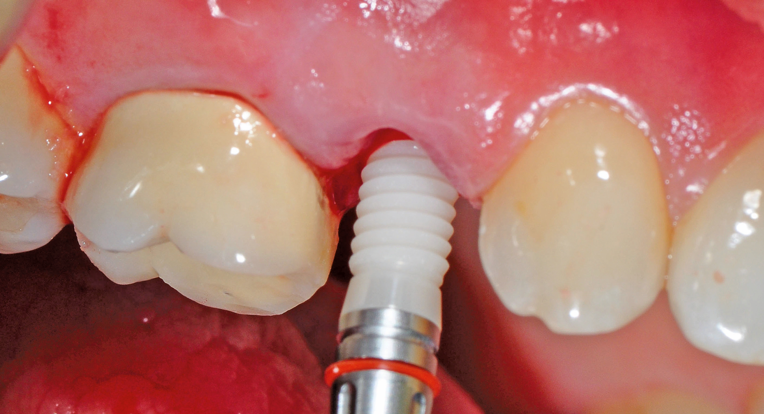 Langsam wurde das yttriumstabilisierte Implantat in das Knochenbett inseriert.
