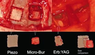 Vergleich des Knochenverlustes wenn ein 1 cm² großer Knochenblock mit einem Piezotome (Piezo), einer Mikrofräse (Micro-Bur) oder mit einem Er:YAG-Laser (Erb:YAG) ausgeschnitten wird.