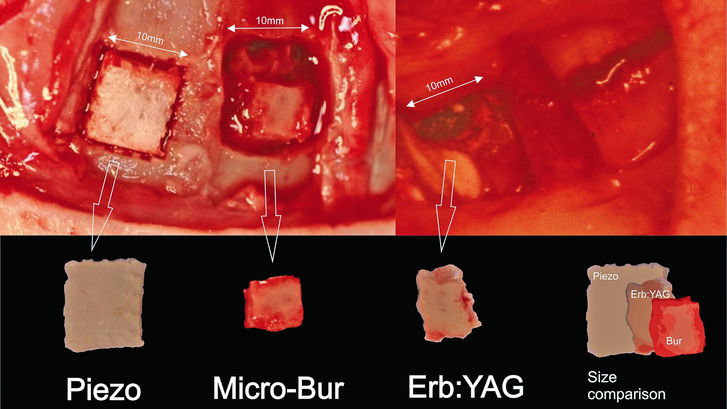 Vergleich des Knochenverlustes wenn ein 1 cm² großer Knochenblock mit einem Piezotome (Piezo), einer Mikrofräse (Micro-Bur) oder mit einem Er:YAG-Laser (Erb:YAG) ausgeschnitten wird.
