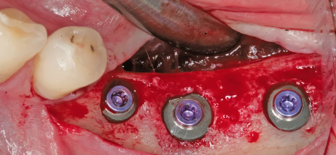 Insertion von drei Implantaten mit den Durchmessern 4, 6 und 5 mm.