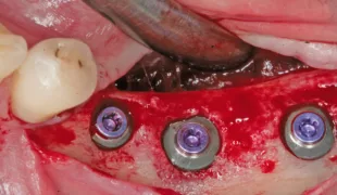 Insertion von drei Implantaten mit den Durchmessern 4, 6 und 5 mm.