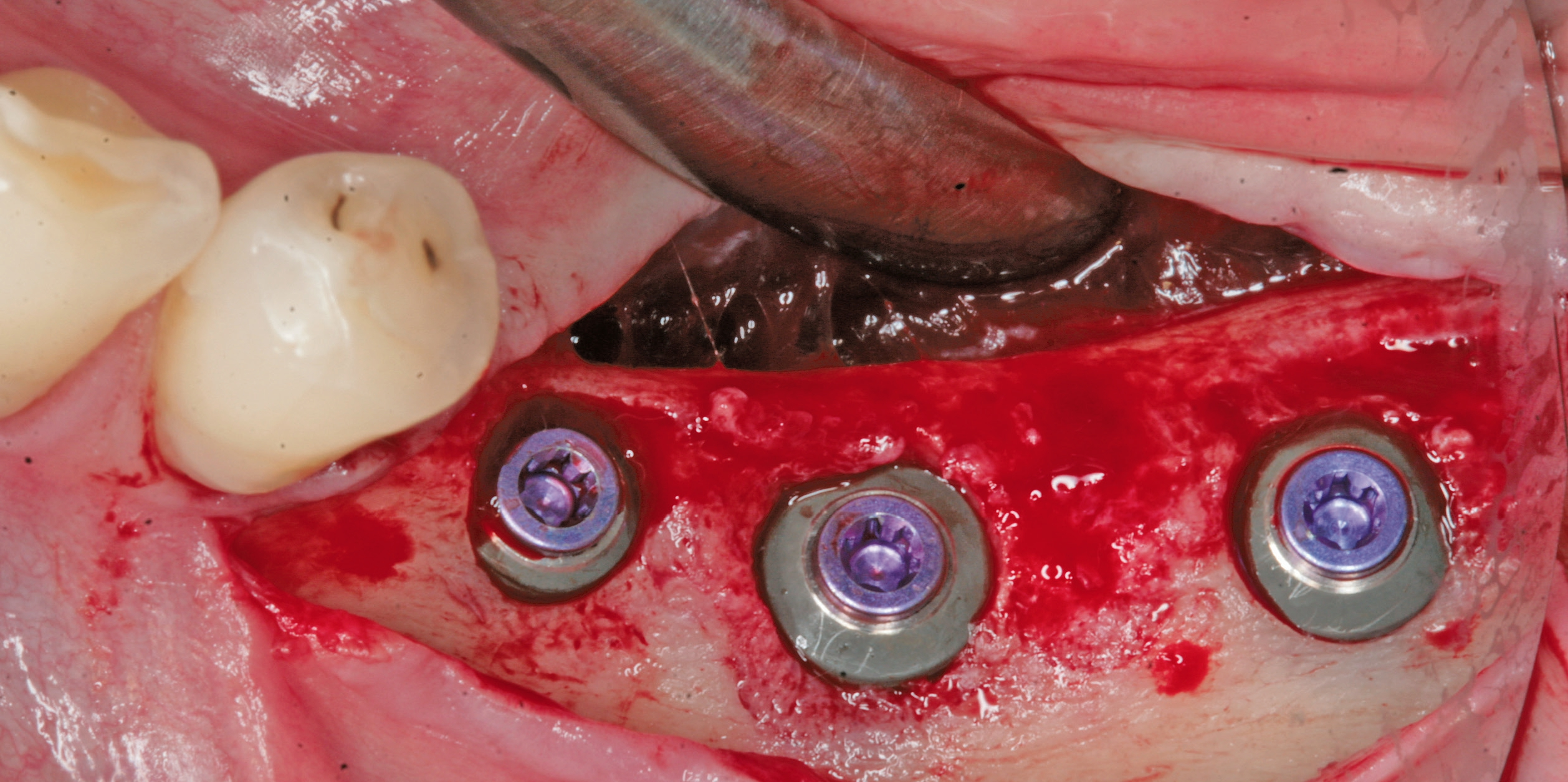 Insertion von drei Implantaten mit den Durchmessern 4, 6 und 5 mm.