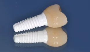 Implantatsystem NobelPearl.