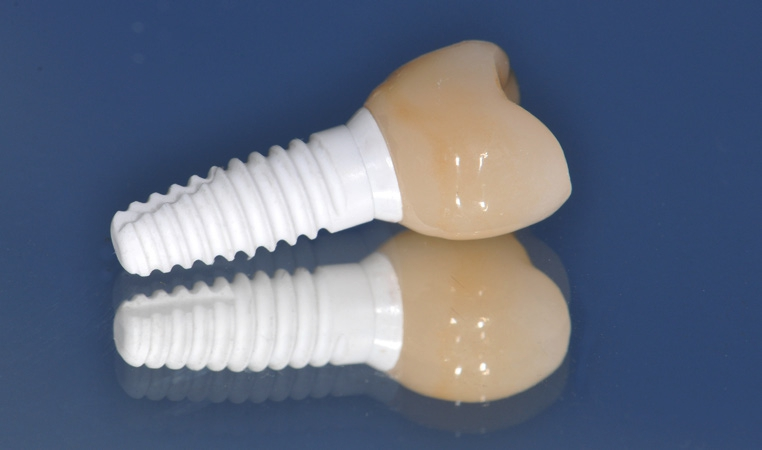 Implantatsystem NobelPearl.