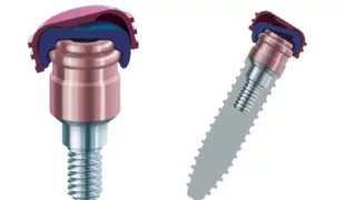 Das Verankerungssystem LOCATOR R-Tx ist eine zukunftsfähige Therapieoption.