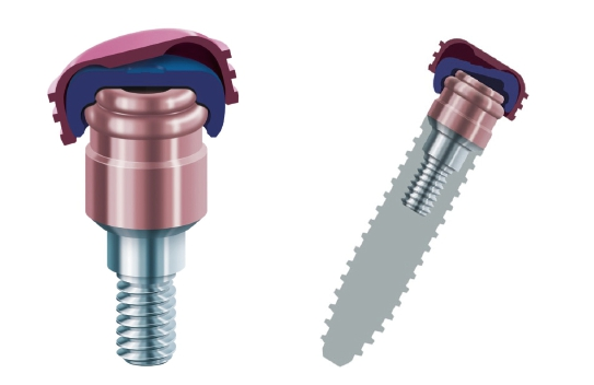 Das Verankerungssystem LOCATOR R-Tx ist eine zukunftsfähige Therapieoption.