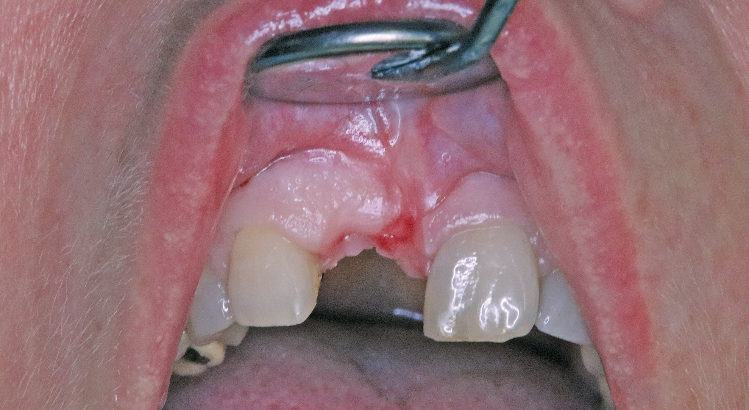 Abb. 1: Ausgangsbefund: Eingefallene keratinisierte Gingiva im zahnlosen Bereich 11, einhergehend mit einer sichtbaren Atrophie.