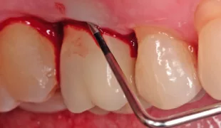 Blutung auf Sondieren um ein Implantat.