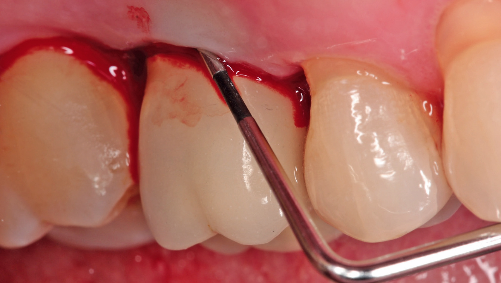 Blutung auf Sondieren um ein Implantat.