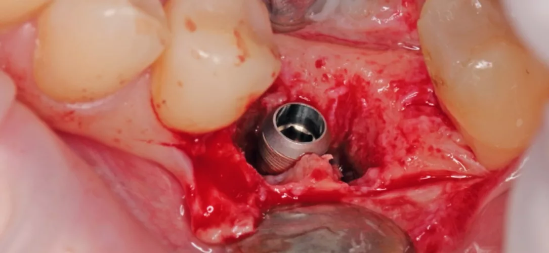 Implantatinsertion.