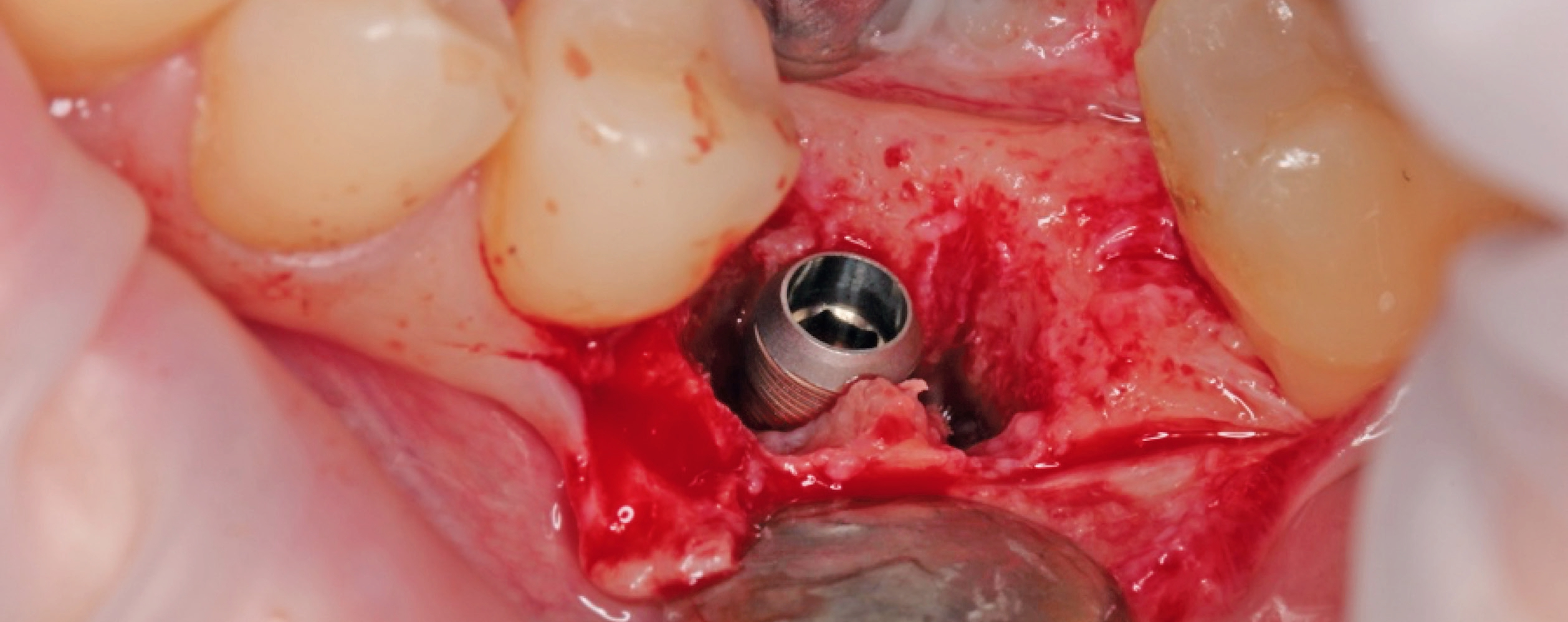 Implantatinsertion.
