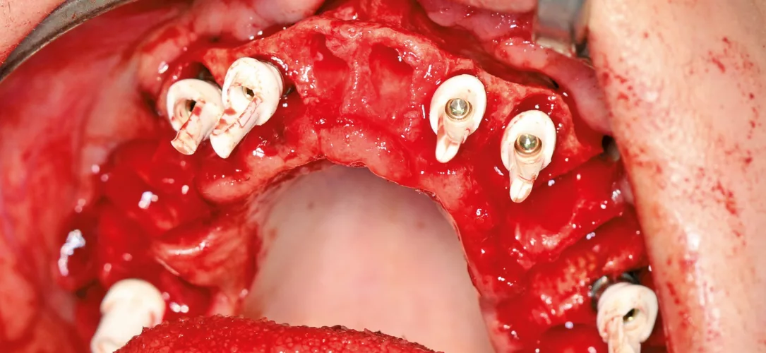 Inserierte Megagen Fuse Abutments.