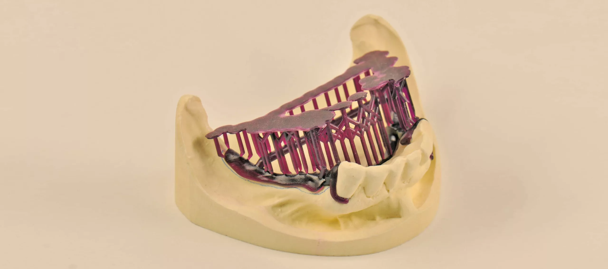 Im SLA-Druckverfahren Castable Wax Formlabs gedruckte Modellguss-Modellation.