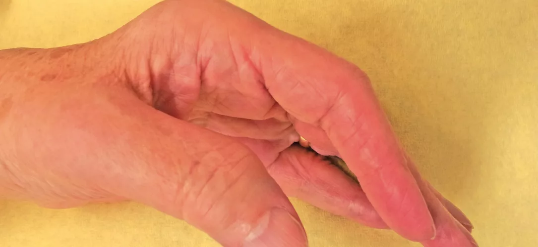 Abb. 1: Hand einer Patientin mit rheumatoider Arthritis.