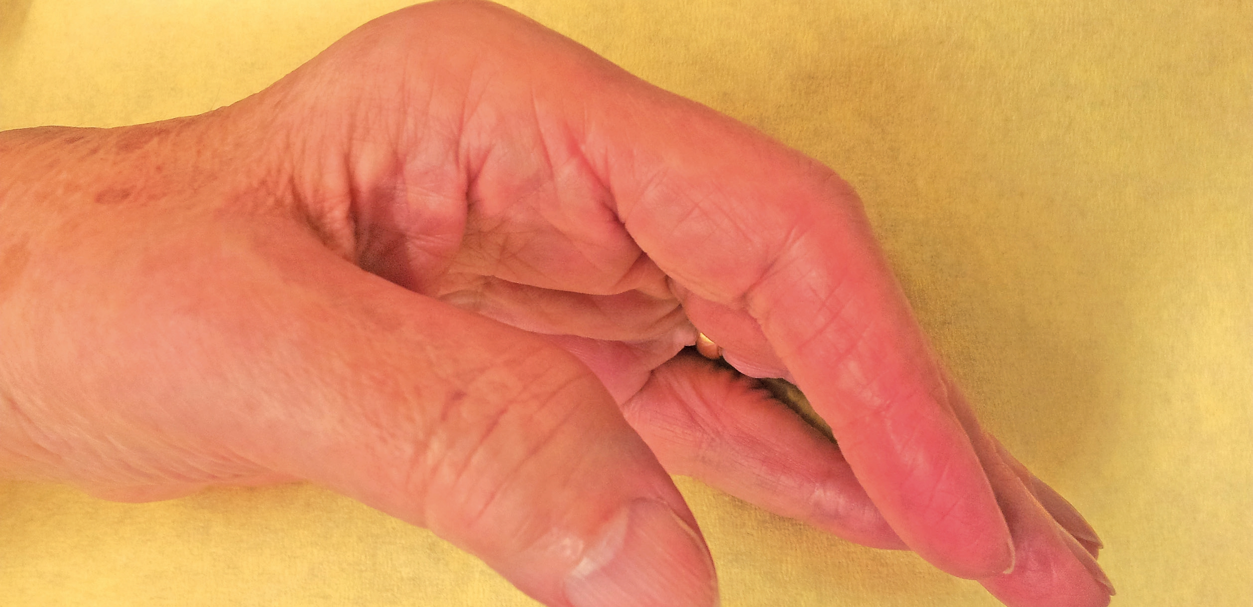 Abb. 1: Hand einer Patientin mit rheumatoider Arthritis.
