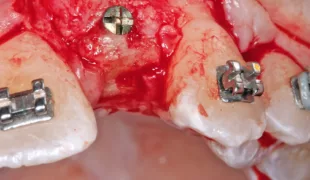Insertion der Implantate nach viereinhalbmonatiger Einheilung der allogenen Knochenblöcke.