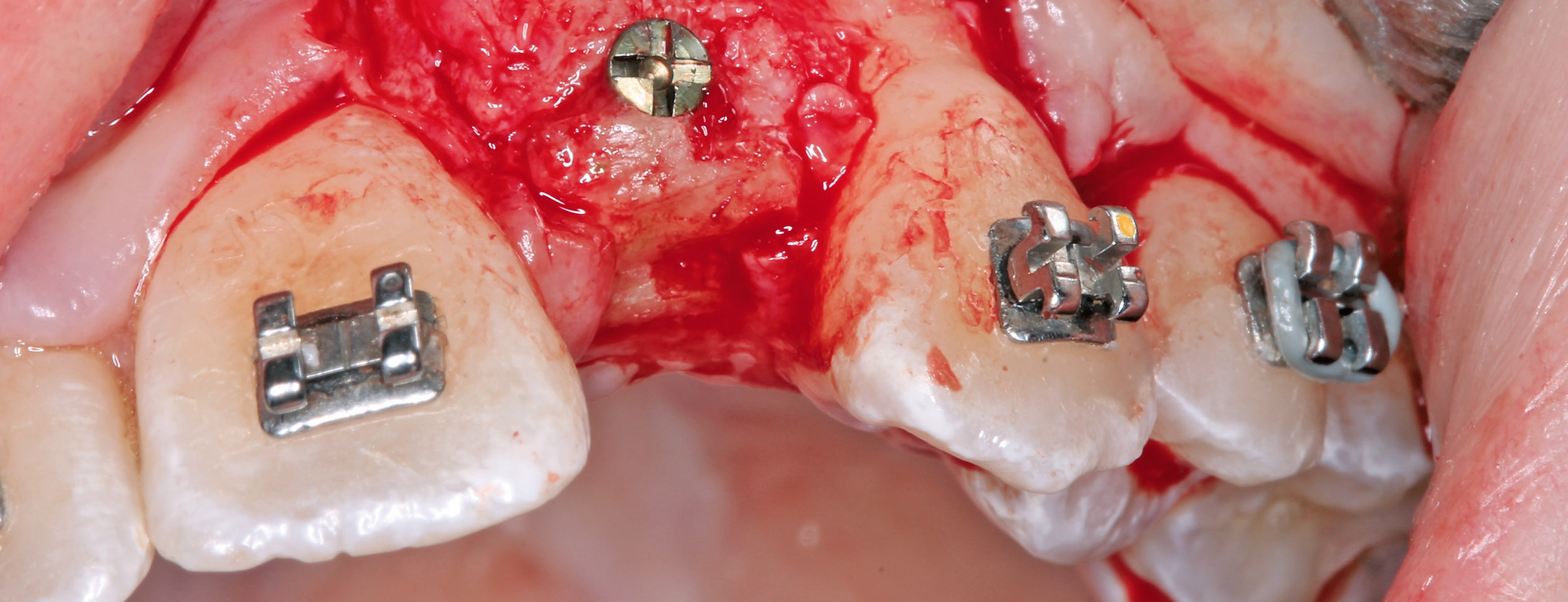 Insertion der Implantate nach viereinhalbmonatiger Einheilung der allogenen Knochenblöcke.
