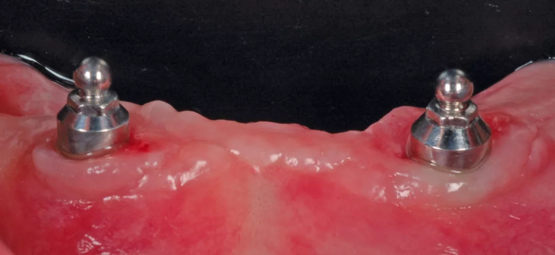 Implantate mit geringen Winkelabweichungen.