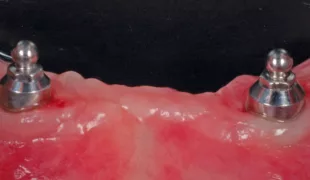 Implantate mit geringen Winkelabweichungen.
