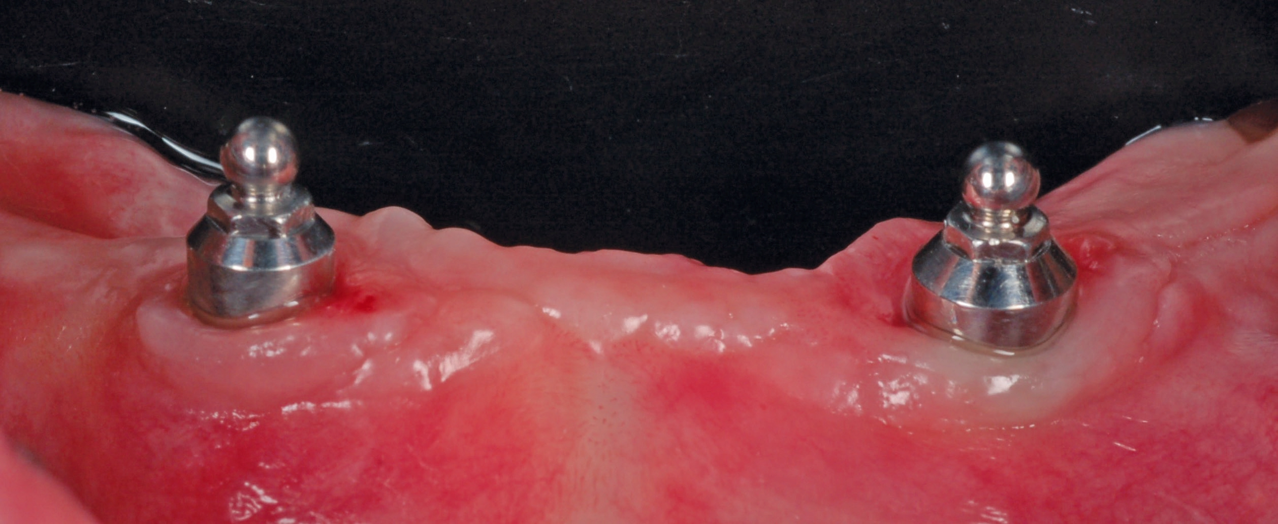 Implantate mit geringen Winkelabweichungen.