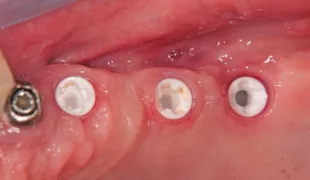 Ansicht der neuen Implantat-Anschlussgeometrie