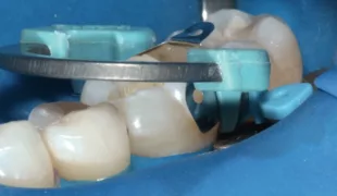 Abb. 1: Einsatz des Palodent V3-Teilmatrizensystem zur guten Abdichtung des gingival-axialen Bereichs; hier der NiTi-Ring Universal in der Matrizengröße 6,5 mm (Foto: Reis).