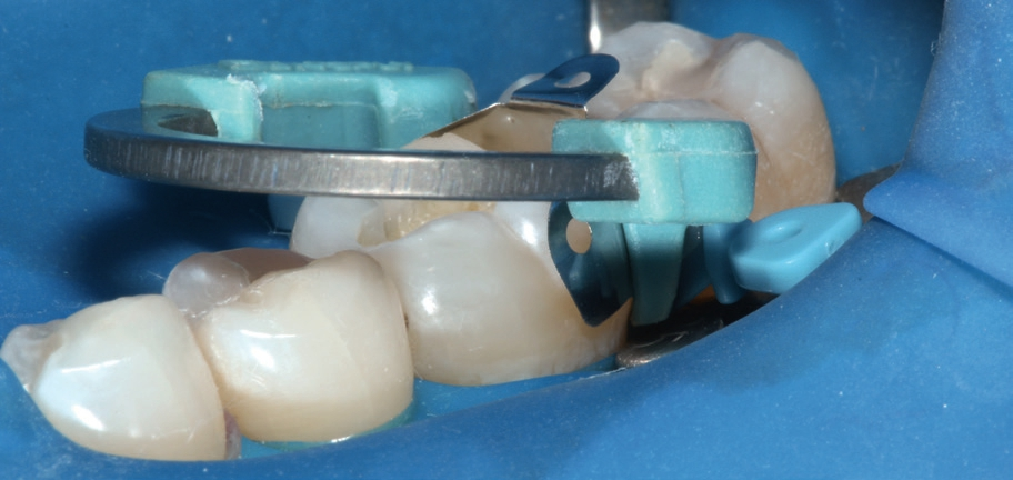 Abb. 1: Einsatz des Palodent V3-Teilmatrizensystem zur guten Abdichtung des gingival-axialen Bereichs; hier der NiTi-Ring Universal in der Matrizengröße 6,5 mm (Foto: Reis).