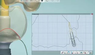 Virtuelle Erstellung des Emergenzprofils.